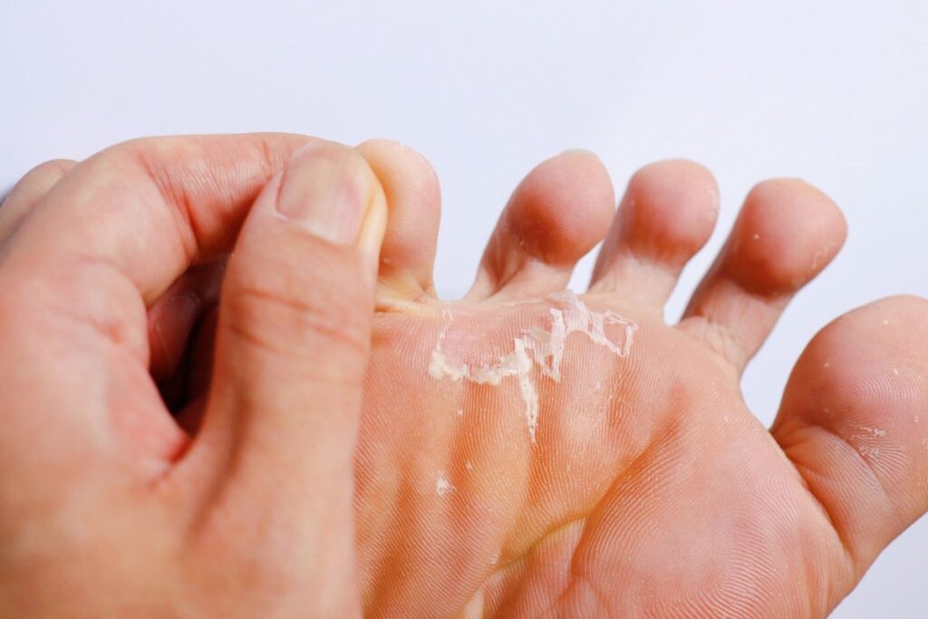 A foot infested with mild Athlete's Foot (Tinea Pedis)